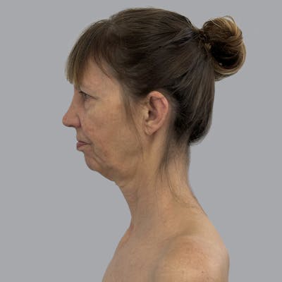 Facelift and Neck Lift Before & After Gallery - Patient 389994 - Image 5