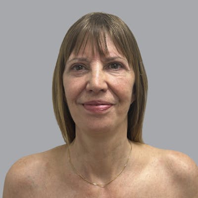 Facelift and Neck Lift Before & After Gallery - Patient 389994 - Image 2