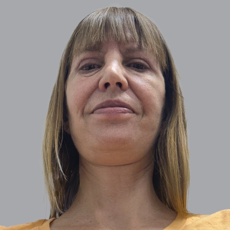 Facelift and Neck Lift Before & After Gallery - Patient 389994 - Image 8