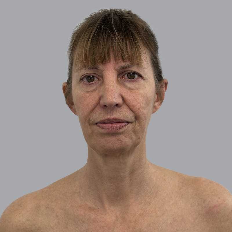Facelift and Neck Lift Before & After Gallery - Patient 389994 - Image 1