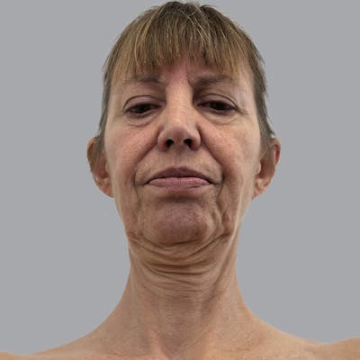 Facelift and Neck Lift Before & After Gallery - Patient 389994 - Image 7