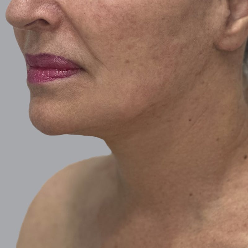 Facelift and Neck Lift Before & After Gallery - Patient 244234 - Image 4