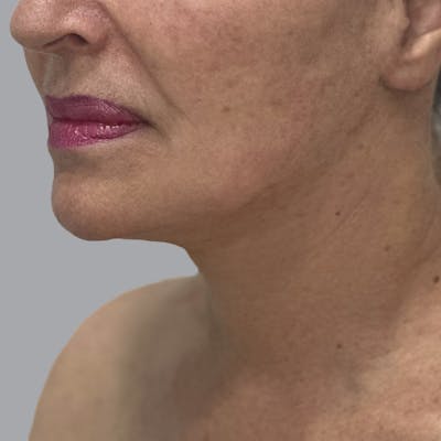 Facelift and Neck Lift Before & After Gallery - Patient 244234 - Image 4