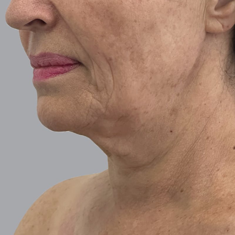 Facelift and Neck Lift Before & After Gallery - Patient 244234 - Image 3