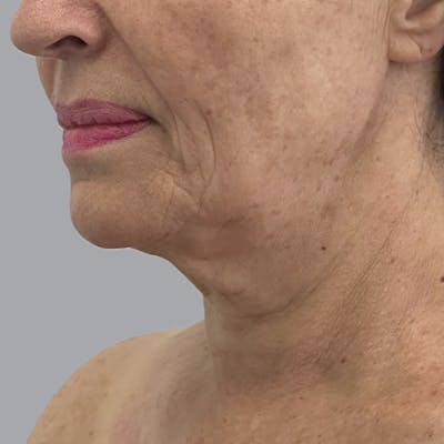 Facelift and Neck Lift Before & After Gallery - Patient 244234 - Image 3