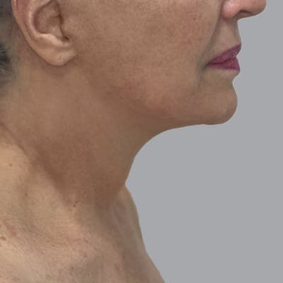 Facelift and Neck Lift Before & After Gallery - Patient 244234 - Image 2