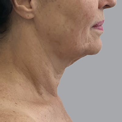 Facelift and Neck Lift Before & After Gallery - Patient 244234 - Image 1