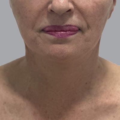 Facelift and Neck Lift Before & After Gallery - Patient 244234 - Image 6