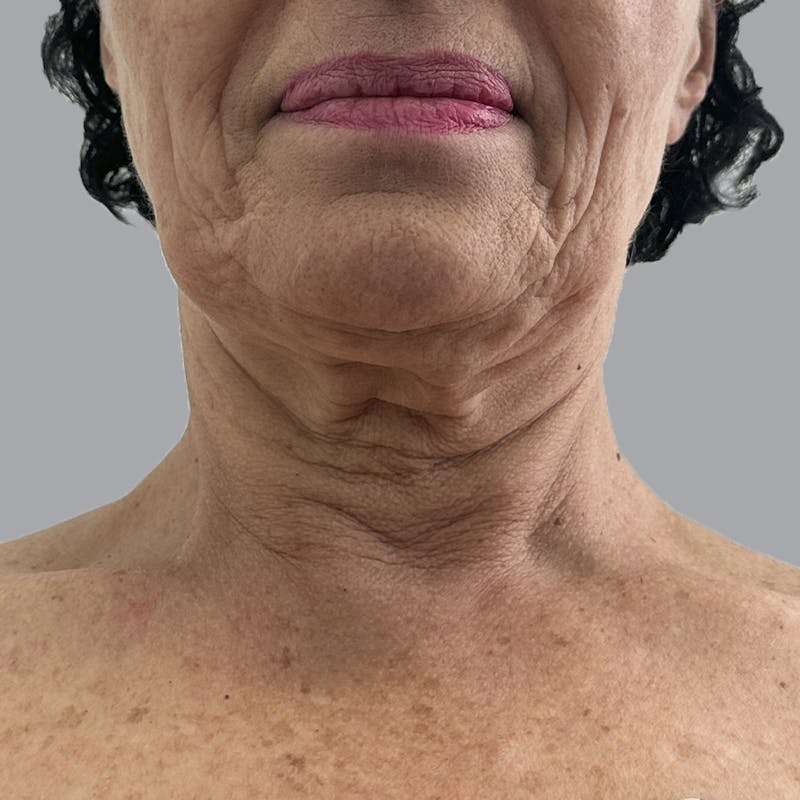 Facelift and Neck Lift Before & After Gallery - Patient 244234 - Image 5
