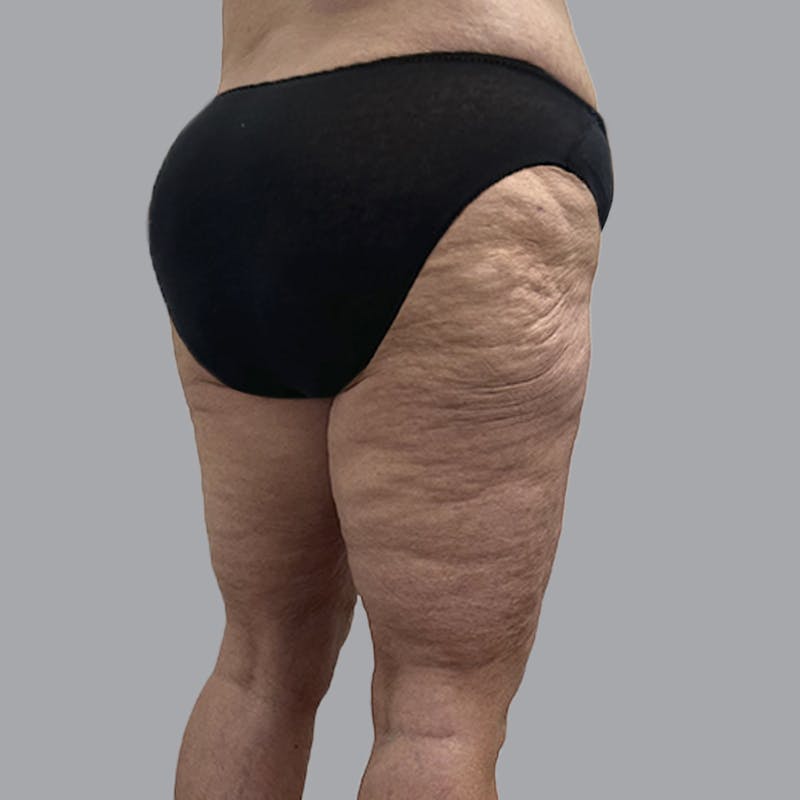 Lipedema Before & After Gallery - Patient 405236 - Image 4