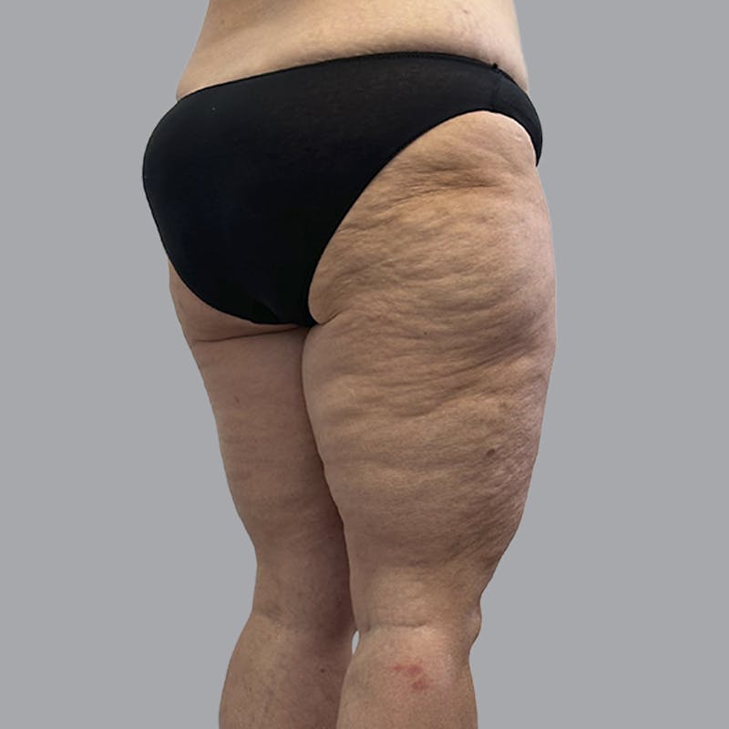 Lipedema Before & After Gallery - Patient 405236 - Image 3