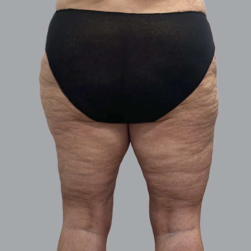 Lipedema Before & After Gallery - Patient 405236 - Image 6