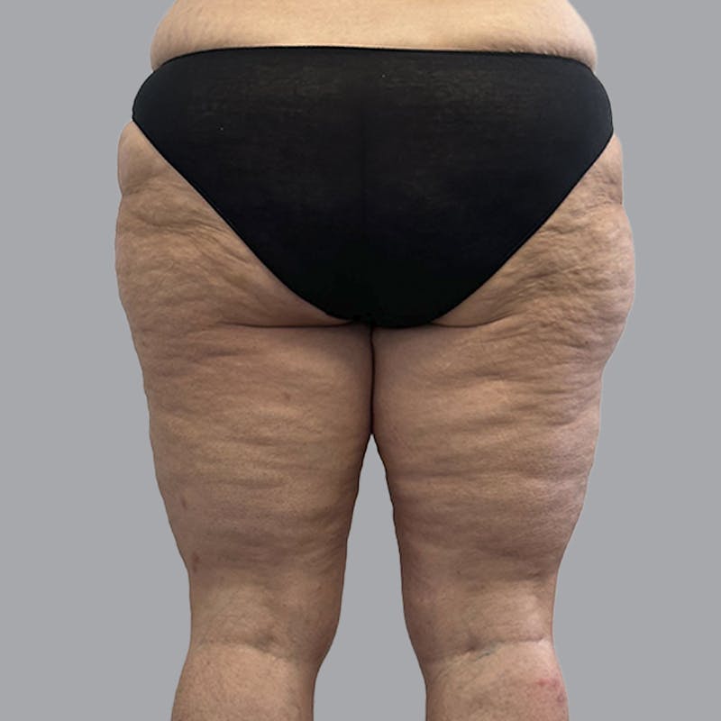 Lipedema Before & After Gallery - Patient 405236 - Image 5