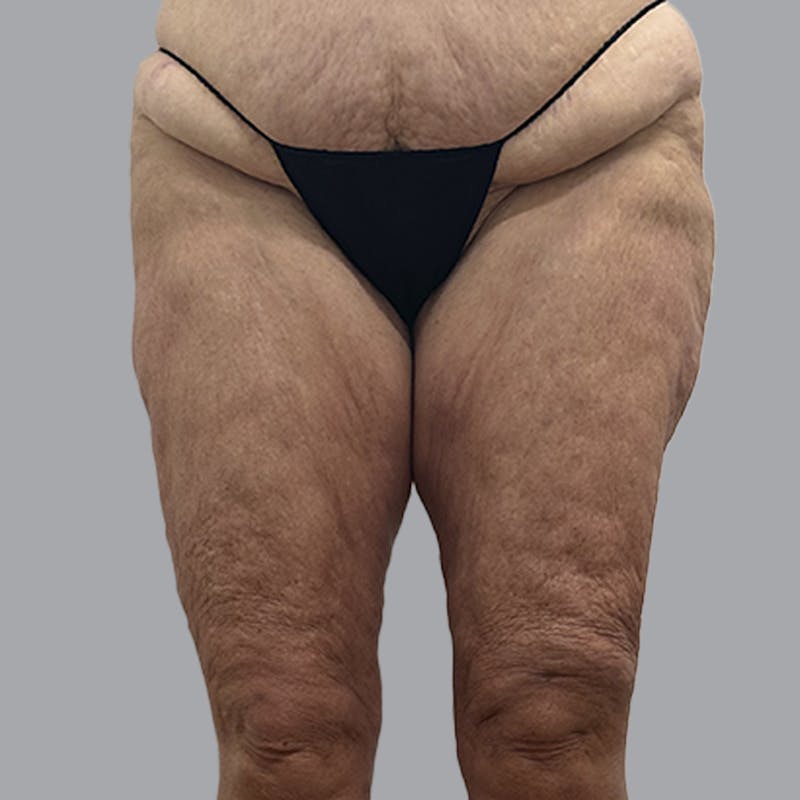 Lipedema Before & After Gallery - Patient 405236 - Image 2
