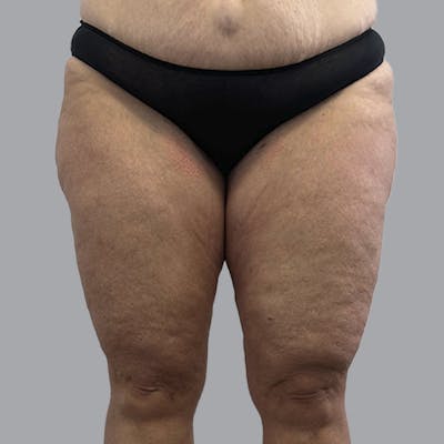 Lipedema Before & After Gallery - Patient 405236 - Image 1