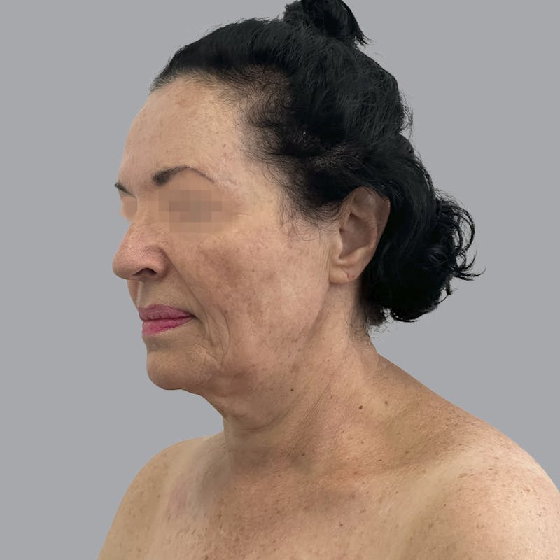 Facelift and Neck Lift Before & After Gallery - Patient 280863 - Image 3