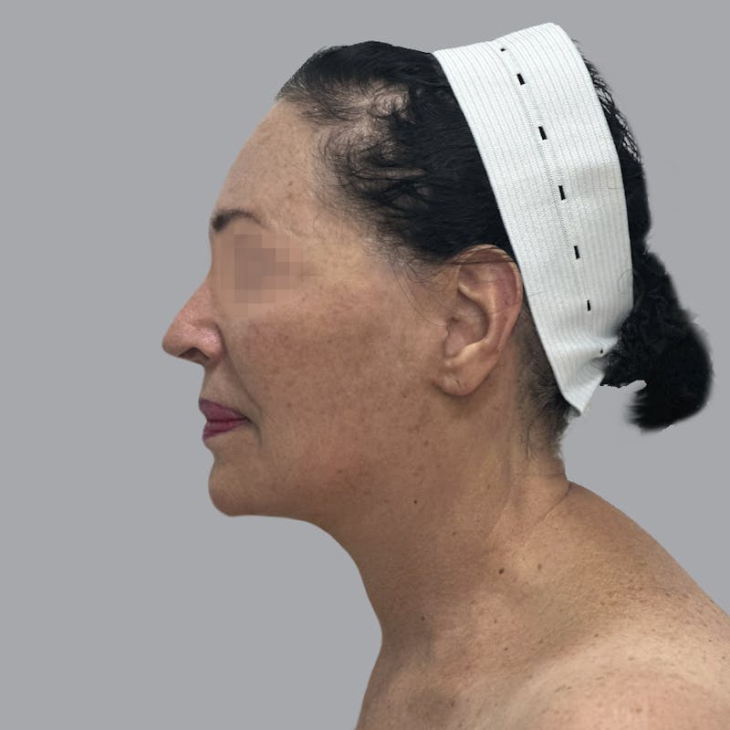 Facelift and Neck Lift Before & After Gallery - Patient 280863 - Image 6