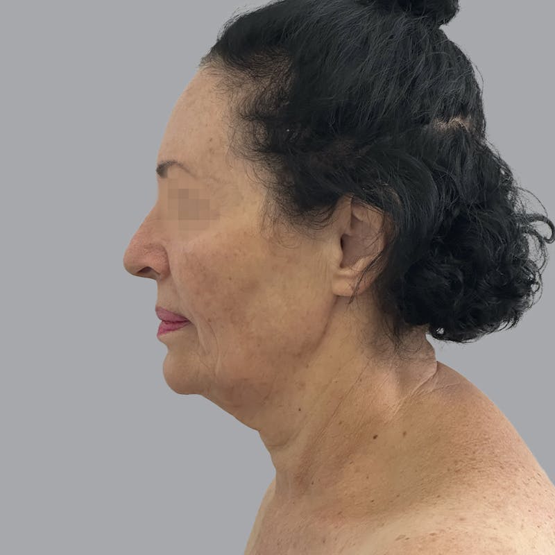 Facelift and Neck Lift Before & After Gallery - Patient 280863 - Image 5