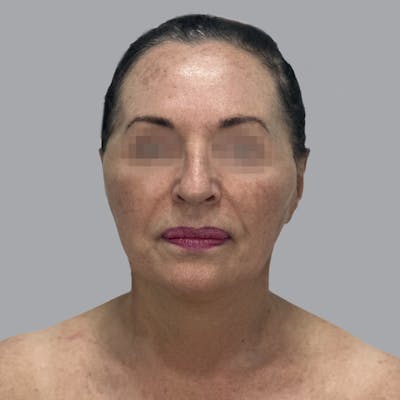 Facelift and Neck Lift Before & After Gallery - Patient 280863 - Image 2