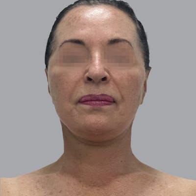 Facelift and Neck Lift Before & After Gallery - Patient 280863 - Image 8