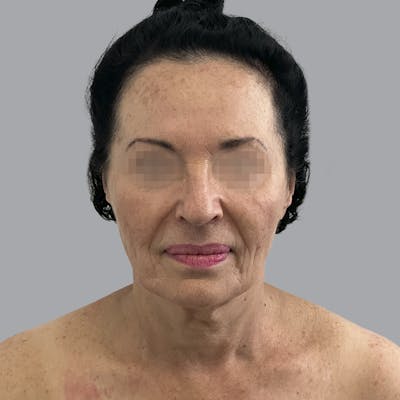 Facelift and Neck Lift Before & After Gallery - Patient 280863 - Image 1