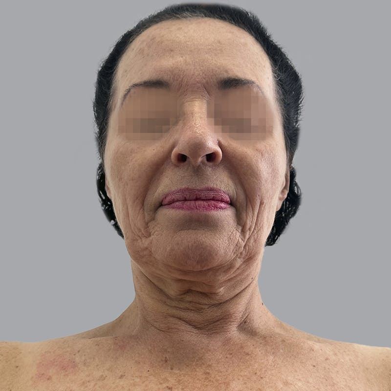 Facelift and Neck Lift Before & After Gallery - Patient 280863 - Image 7