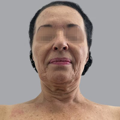 Facelift and Neck Lift Before & After Gallery - Patient 280863 - Image 7