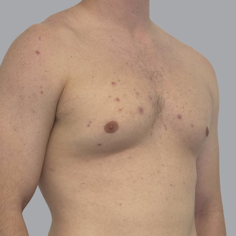 Gynecomastia Before & After Gallery - Patient 216842 - Image 3