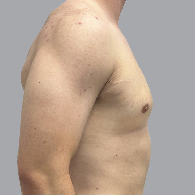Gynecomastia Before & After Gallery - Patient 216842 - Image 6