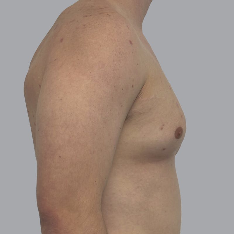 Gynecomastia Before & After Gallery - Patient 216842 - Image 5