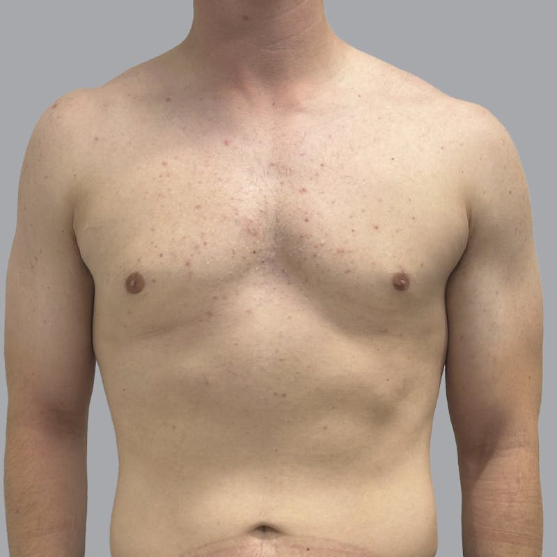 Gynecomastia Before & After Gallery - Patient 216842 - Image 2