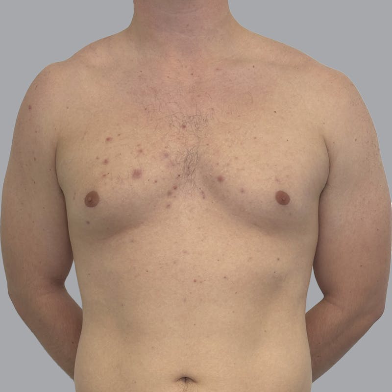 Gynecomastia Before & After Gallery - Patient 216842 - Image 1