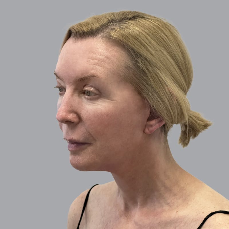 Facelift and Neck Lift Before & After Gallery - Patient 383532 - Image 4