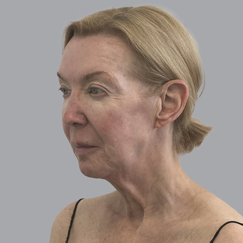 Facelift and Neck Lift Before & After Gallery - Patient 383532 - Image 3
