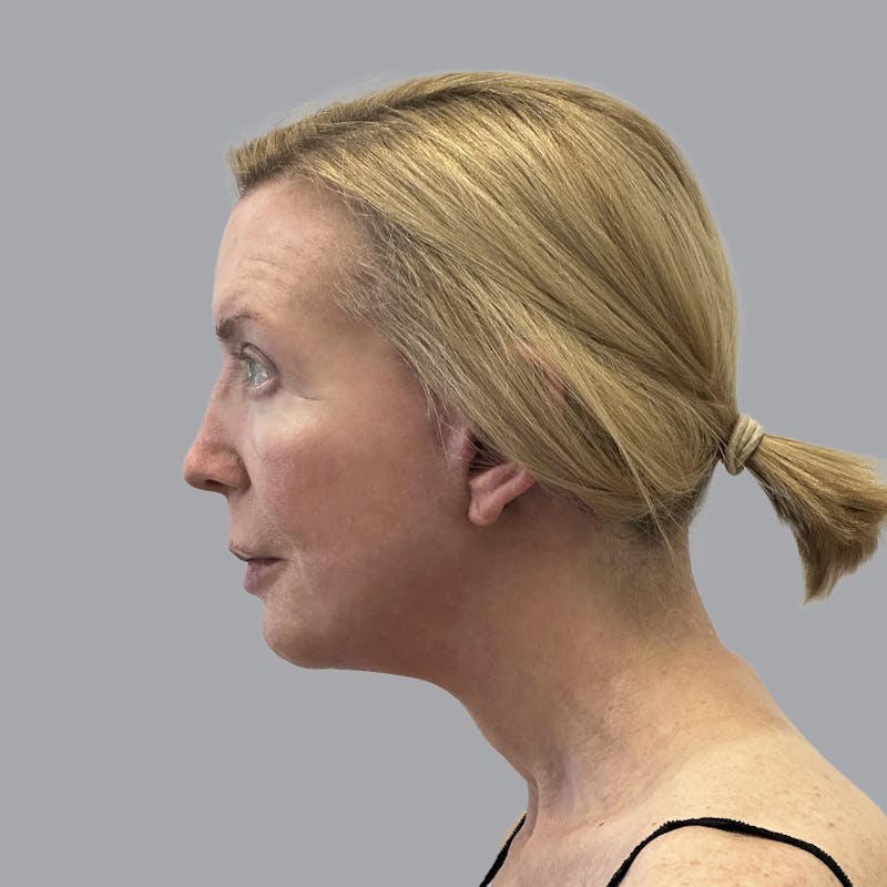 Facelift and Neck Lift Before & After Gallery - Patient 383532 - Image 6