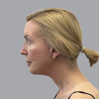 Blepharoplasty in Tampa Before & After Gallery - Patient 225934 - Image 6