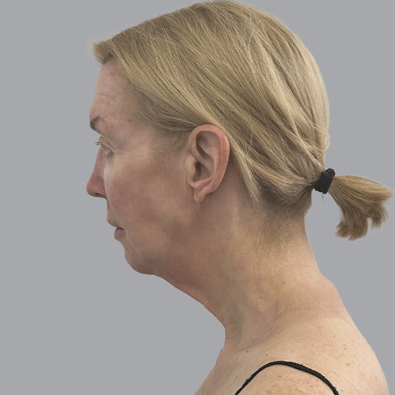 Facelift and Neck Lift Before & After Gallery - Patient 383532 - Image 5