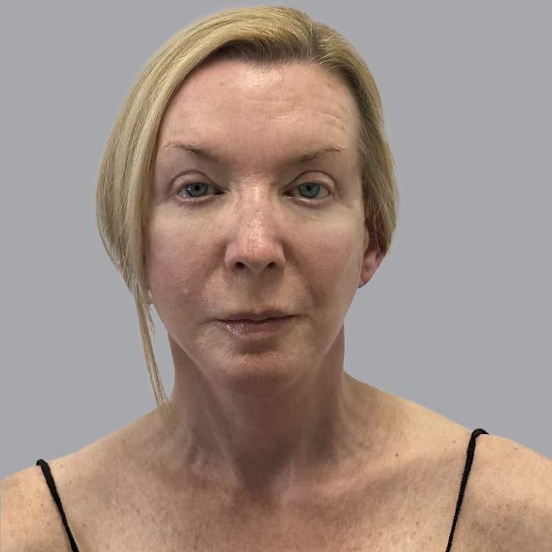 Facelift and Neck Lift Before & After Gallery - Patient 383532 - Image 2