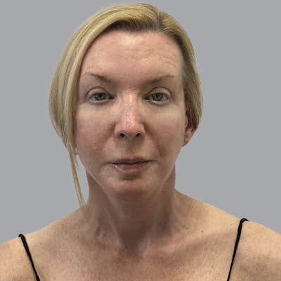 Blepharoplasty Before & After Gallery - Patient 225934 - Image 2