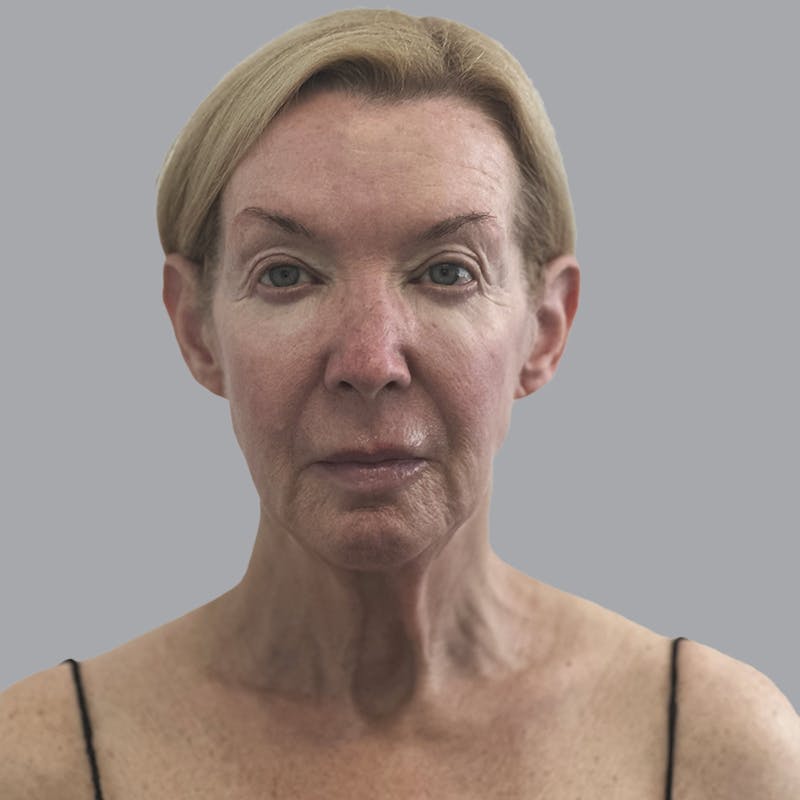 Facelift and Neck Lift Before & After Gallery - Patient 383532 - Image 1
