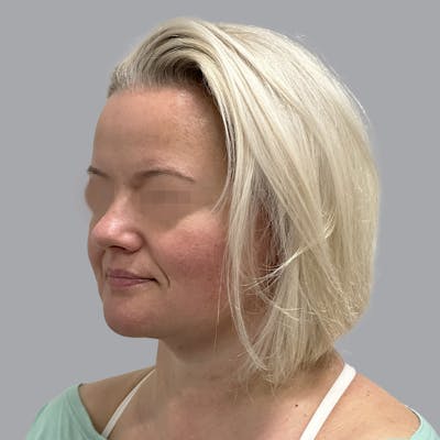 Facelift and Neck Lift Before & After Gallery - Patient 447387 - Image 4