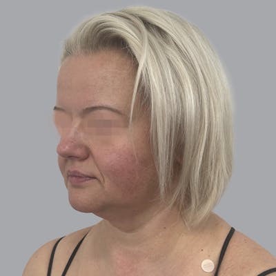 Facelift and Neck Lift Before & After Gallery - Patient 447387 - Image 3