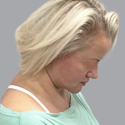 Facelift and Neck Lift Before & After Gallery - Patient 447387 - Image 6