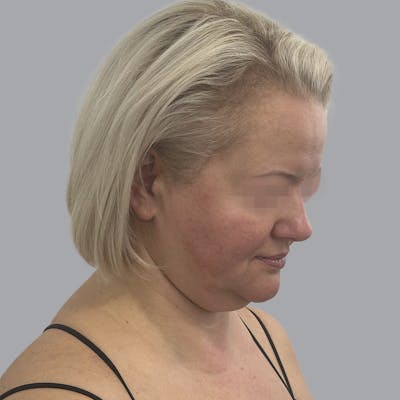 Facelift and Neck Lift Before & After Gallery - Patient 447387 - Image 5