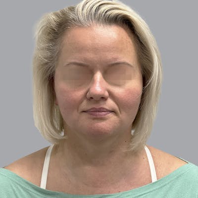 Facelift and Neck Lift Before & After Gallery - Patient 447387 - Image 2