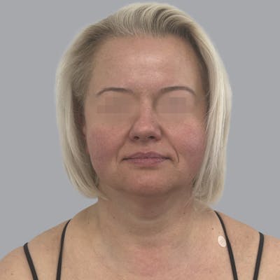 Facelift and Neck Lift Before & After Gallery - Patient 447387 - Image 1