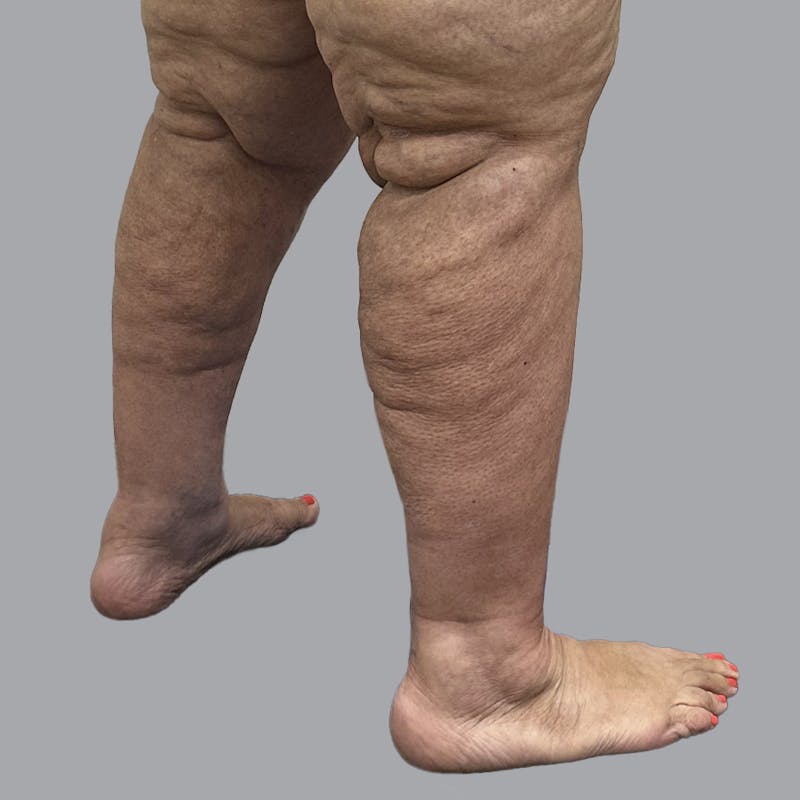 Lipedema Before & After Gallery - Patient 319353 - Image 4