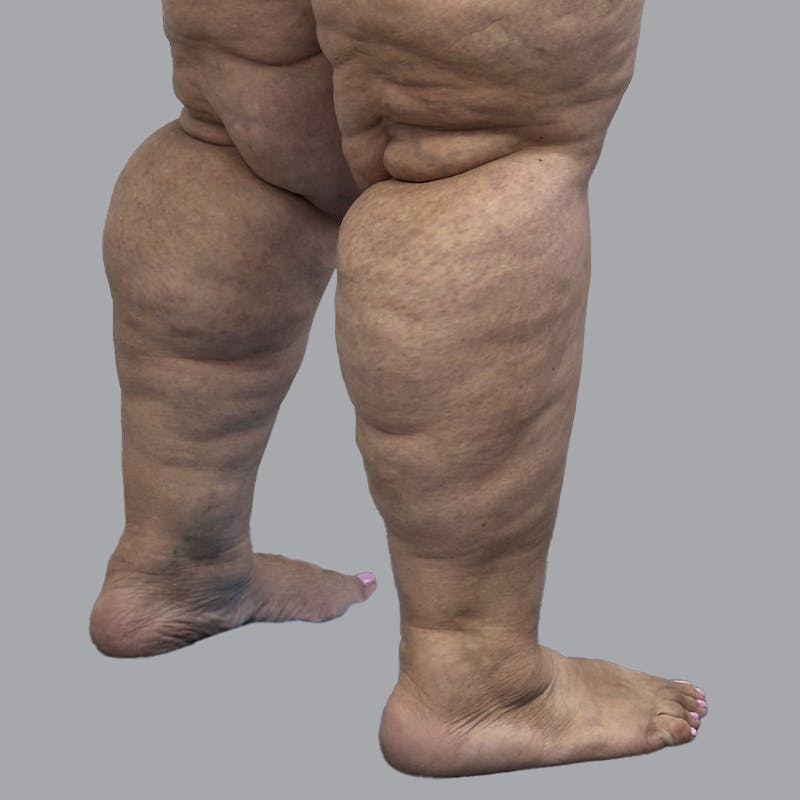 Lipedema Before & After Gallery - Patient 319353 - Image 3