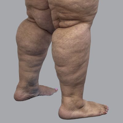 Lipedema Before & After Gallery - Patient 319353 - Image 3
