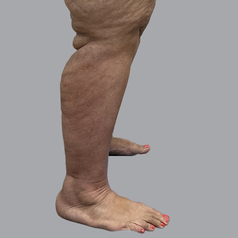 Lipedema Before & After Gallery - Patient 319353 - Image 6